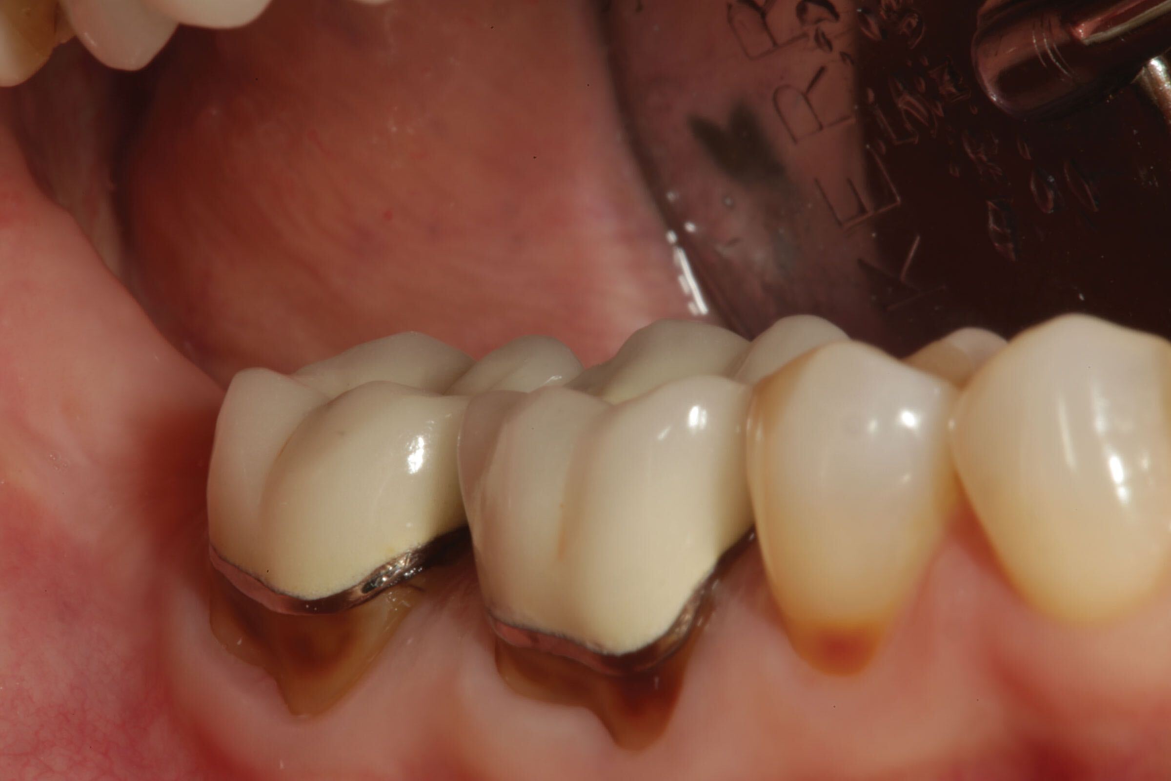 Dental Filling - How Long Does it Take to Fill a Cavity